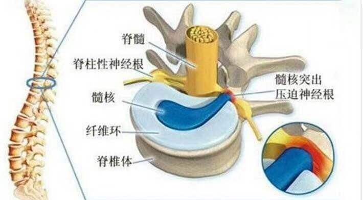 腰椎间盘4和5突出,屁股臀疼是怎么回事?