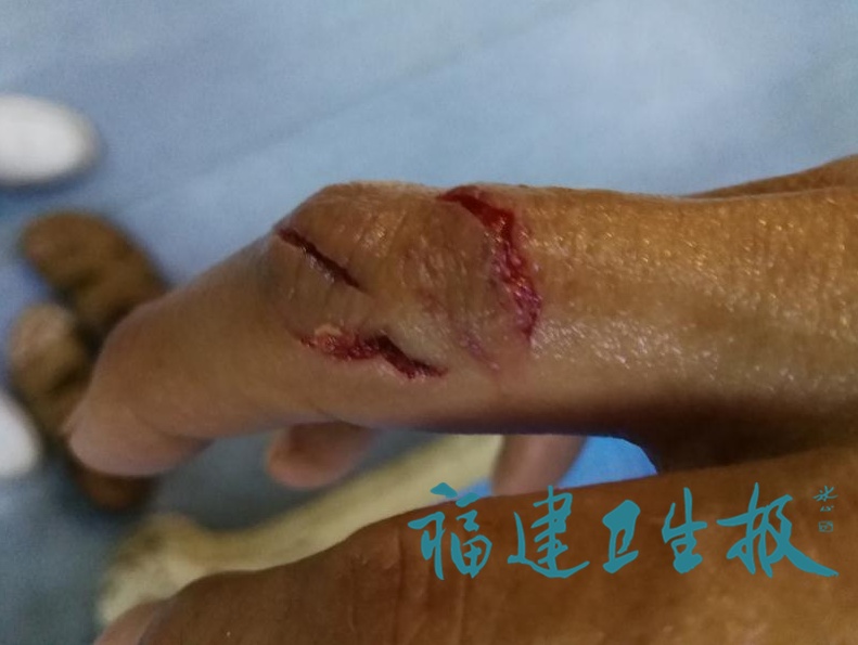 漳州一位阿婆杀鱼时手被刺伤,3天后生命垂危,截肢保命
