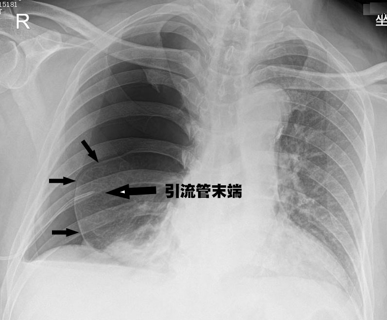 气胸患者引流后胸闷反加重,只因这个小小的疏忽!