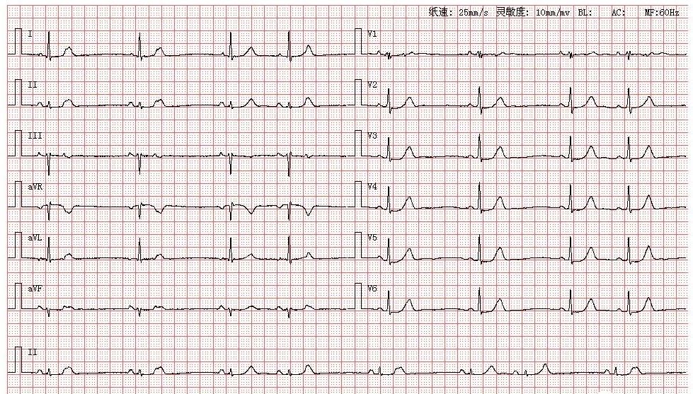 心房,颤动,心电图