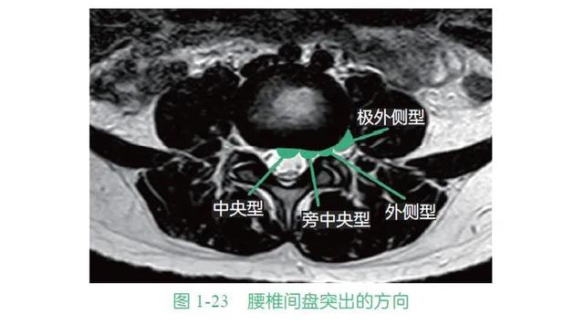 腰椎间盘突出,椎间盘,神经根