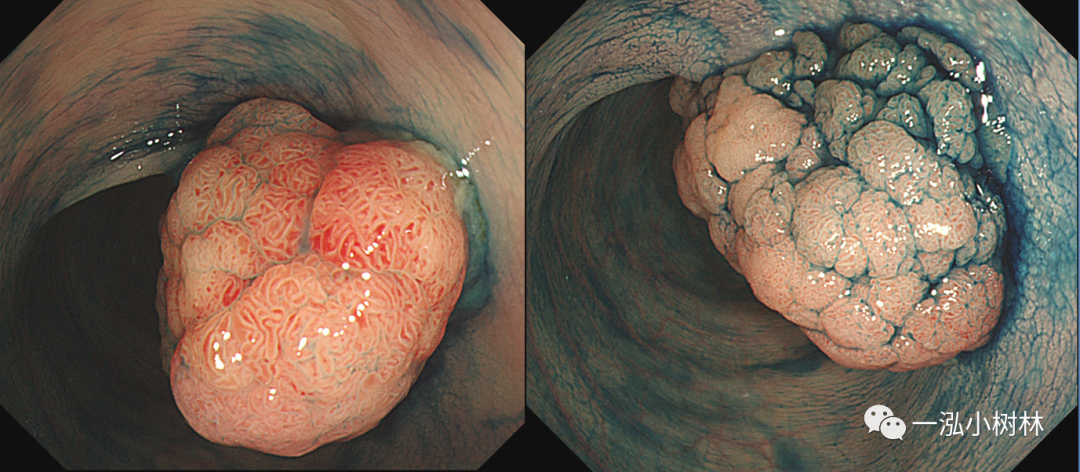 图34 结肠绒毛管状腺瘤 hgin(pit pattern iv型 cf-h260ai)