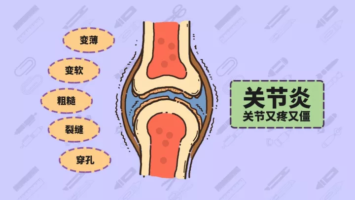 关节炎症状,健康,养生