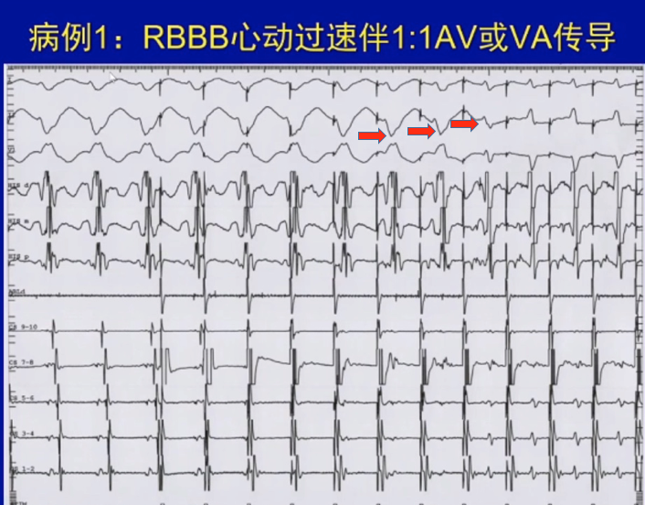 心动过速,室速,室上性心动过速,马坚,心室,日本,心电图,窦性心律