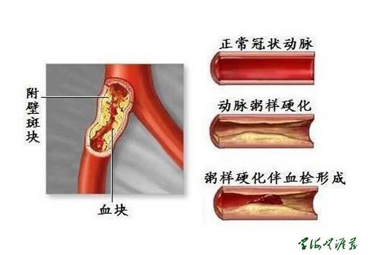 医生,下肢动脉闭塞,截肢,下肢动脉硬化闭塞症,下肢,血管