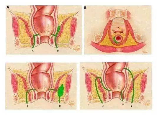 肛周脓肿,脓肿,肛门,肛瘘