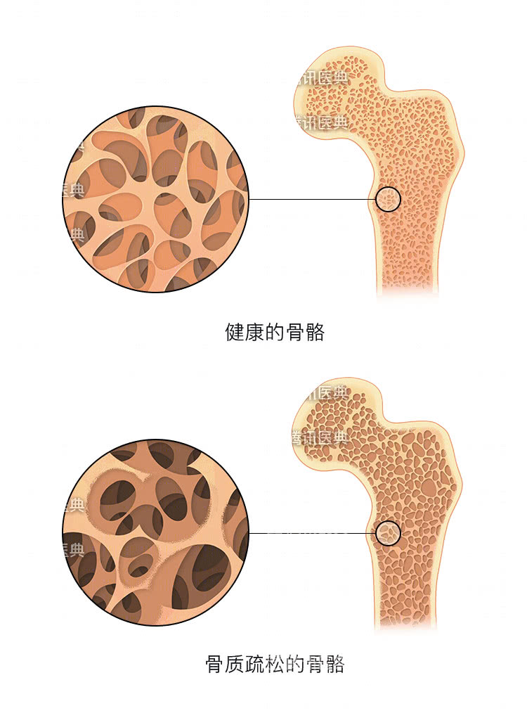 骨质疏松,骨折,补钙,抽筋,骨密度