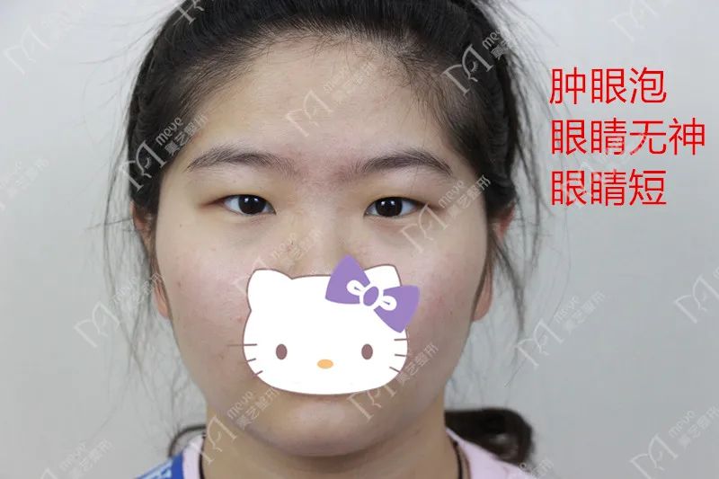肿眼泡小眼睛姑娘双眼皮之后变成了大美女