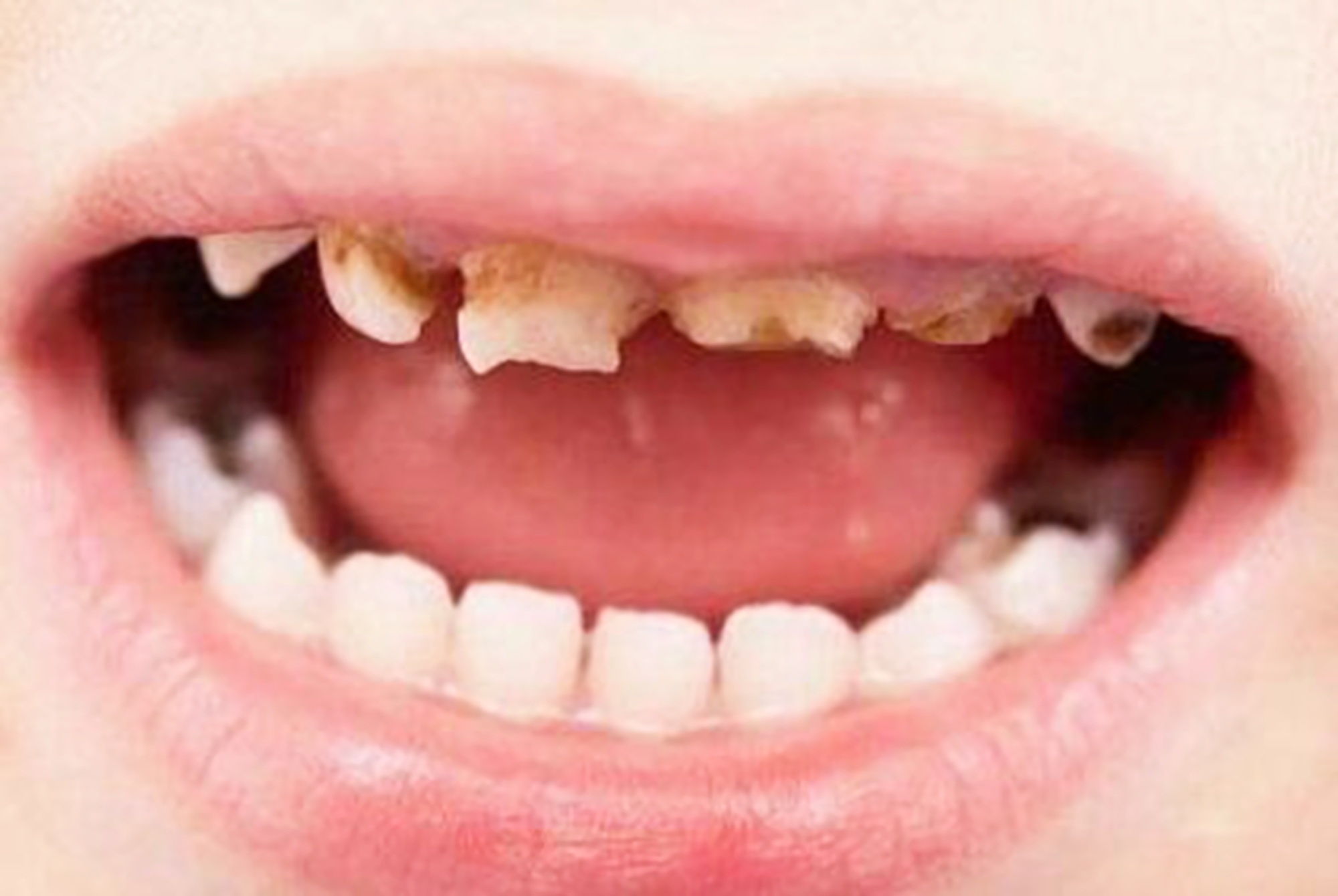 一: 彻底清洁牙齿可以配合使用牙线 孩子患上龋齿和早期的牙齿清洁不