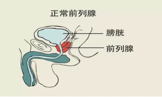 前列腺增生那点事儿