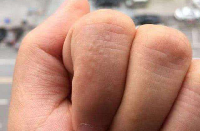 其实这种情况被称为汗疱疹,这是手部的一种特殊的湿疹,一般在手指的