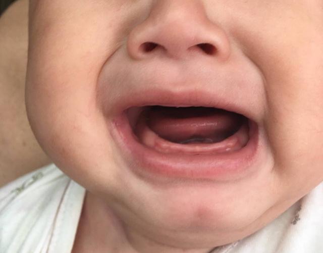 宝宝出牙前有症状,对照出牙时间和顺序,看看你家娃有没有达标?