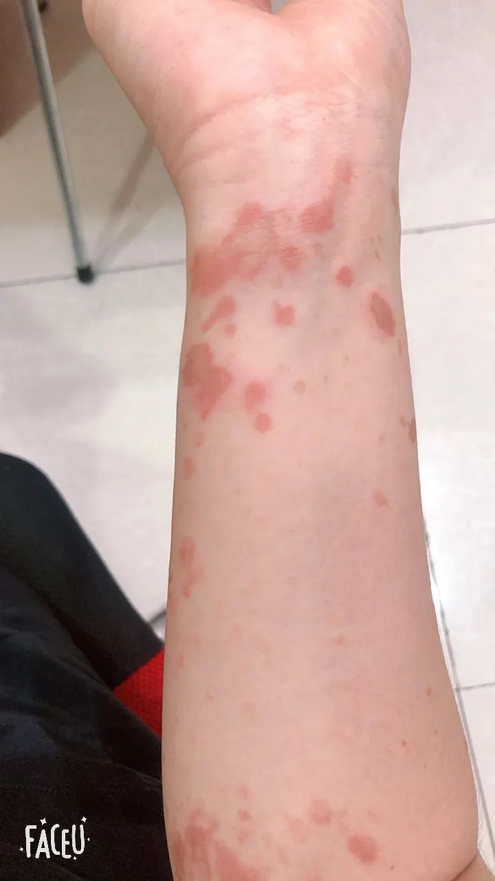 萧山一姑娘做饭时油锅炸了,胳膊被烫成这样!内心阴影太大了