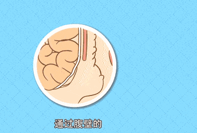 宝宝肚子疼别大意,这种疼妈妈要警惕!超过1岁就要手术