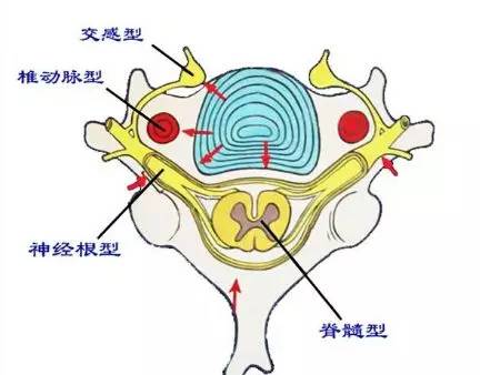 神经根型颈椎的临床应用指南