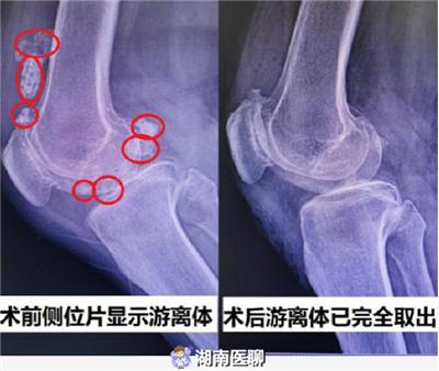 微创"打洞"巧捉"关节鼠"