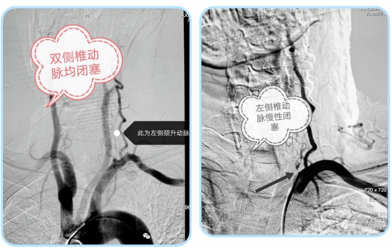 宁津县人民医院首例椎动脉慢性闭塞再通术成功实施
