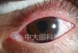 睫毛炎发病图片 腾讯网