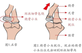 股骨是人体内最粗大的骨骼,外形略似拐热.