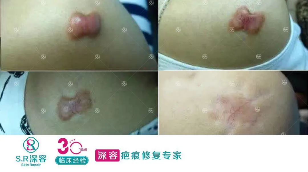 疤痕疙瘩,瘢痕,皮脂腺囊肿,瘙痒