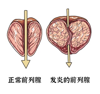 前列腺,康复运动,医生,慢性前列腺炎,前列腺疾病