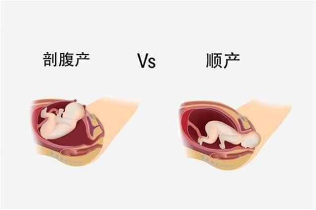 劣势 由于是手术,产妇恢复慢,宝宝的抵抗力相对顺产差一些.