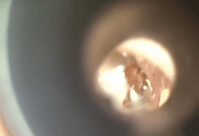 耳屎到底要不要掏?医生这个答案可能让你有点意外!