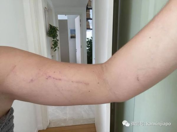 但身体上的疤痕还是无法完全康复,在她身上残留伤痕