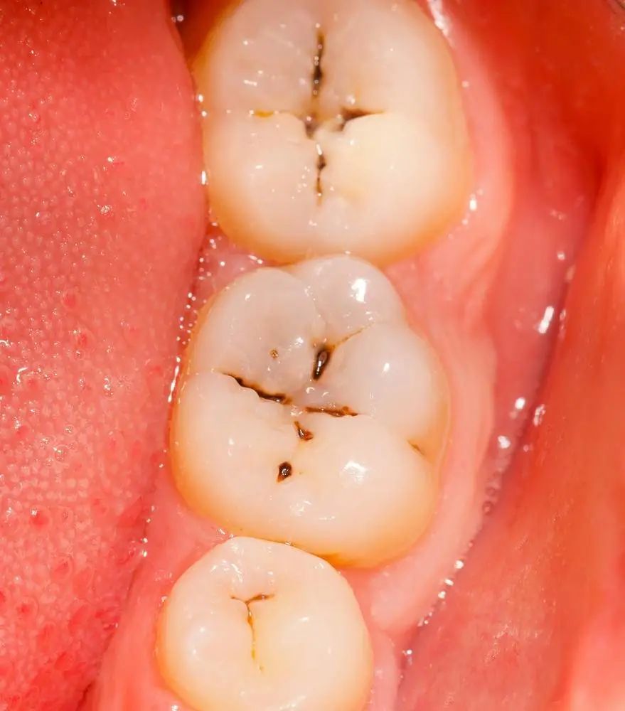 牙疼,牙齿,牙菌斑,口腔异味