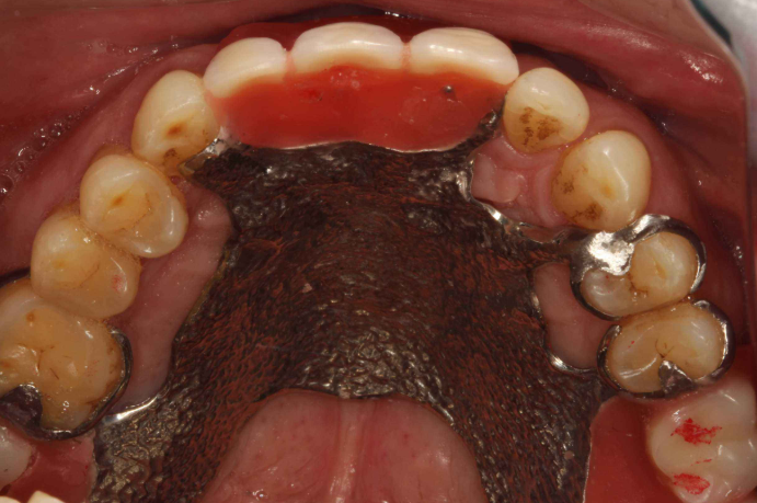 满口坏牙,吃饭吃不动,需要从