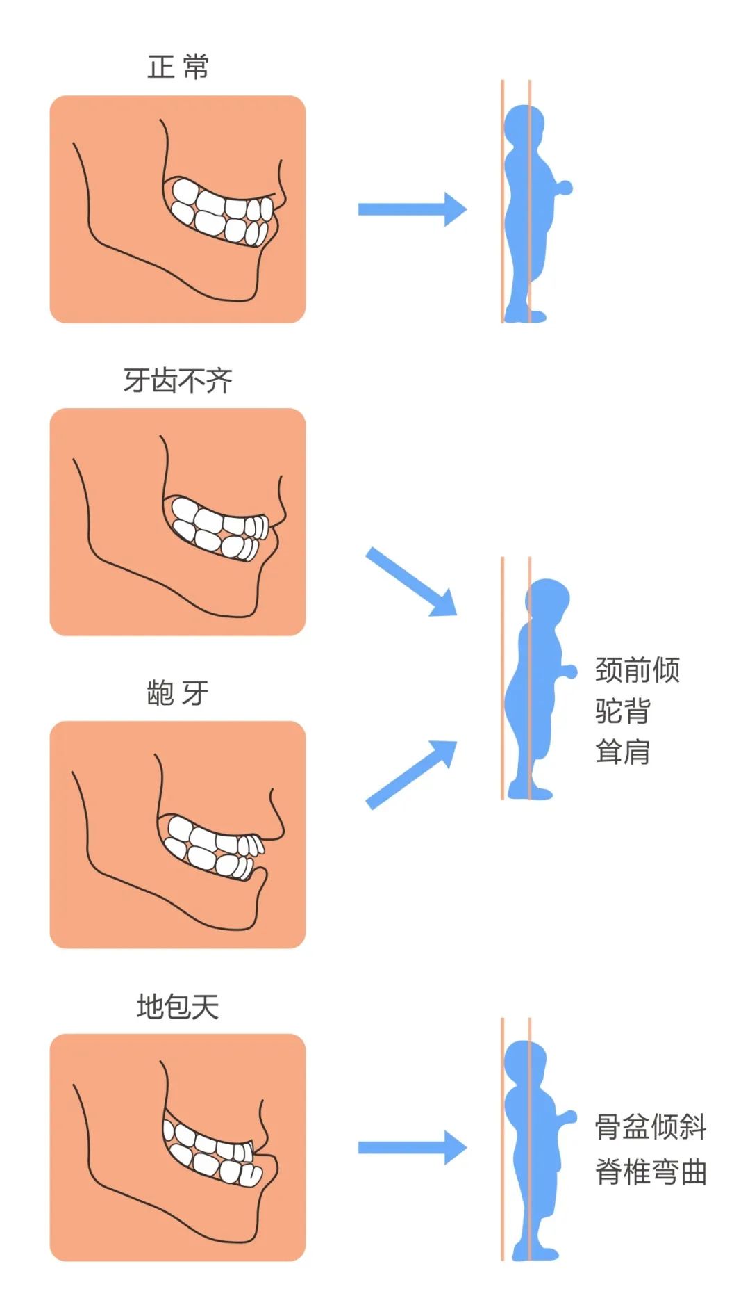 儿童错颌畸形的危害 影响骨骼发展 不良的咬合和用嘴呼吸习