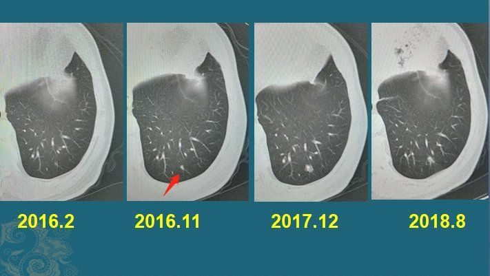 这是一位肺鳞癌患者,2019年增长到3cm以上,从一个小于3mm的实性微结节