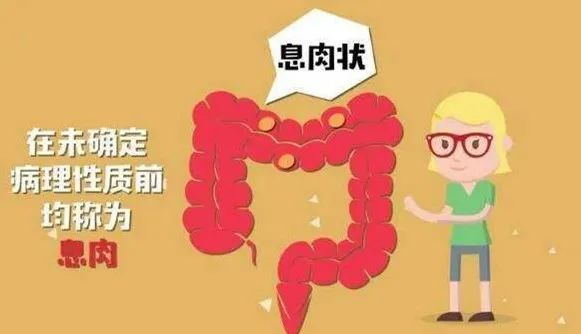 息肉,肠息肉,肠道,肛门,大便出血