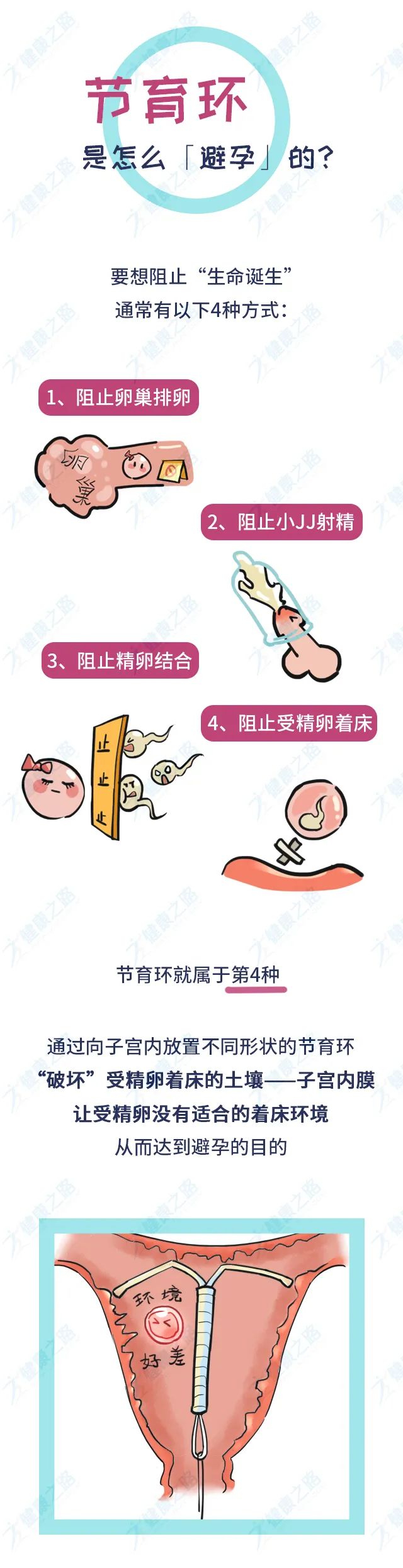 千万中国女性身体里的节育环,到底是避孕神器,还是"定时炸弹?