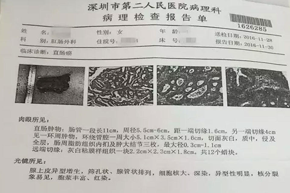 深圳女子体检正常 3天后查出直肠癌中期_hao1