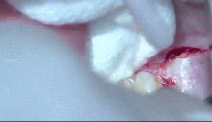 智齿拔完后的注意事项1,遵循医嘱拔牙后要咬住压在伤口上的消毒棉球或