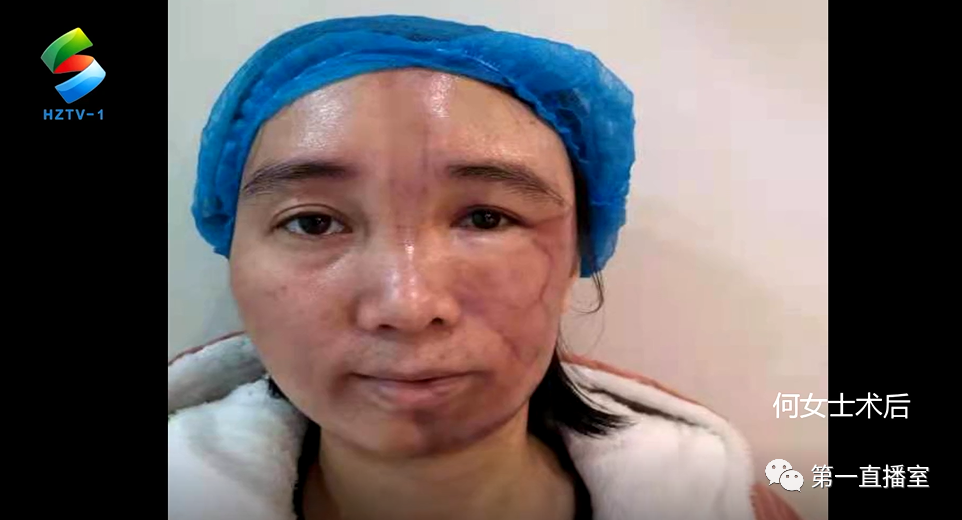 直播室 2020-12-05 17:54 家住淡水的何女士,因患硬皮病导致面部畸形