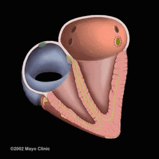 肺静脉处消融房间隔穿刺过程:股静脉穿刺送入导管导管在房间隔进行