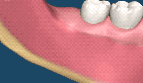 拔牙或致颅内感染肿胀感超过3天就该小心