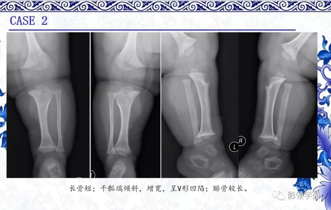 骨软骨发育,医学影像,解剖,x线,mr