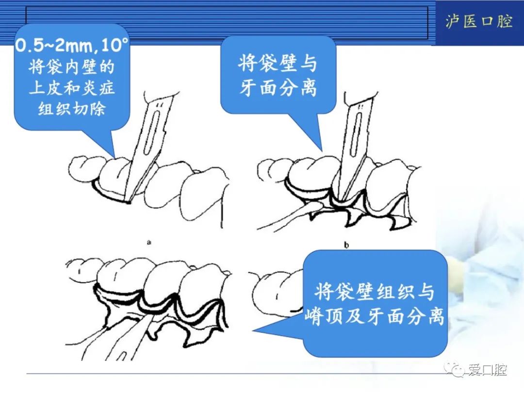 3,有骨下袋形成,需做骨修正或移骨者.