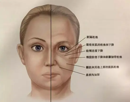 轮廓也就不再紧致除了咬肌与脂肪,下颌缘松弛,嘴角下垂,木偶纹等衰老