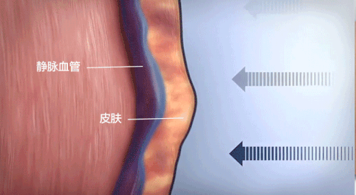 静脉曲张|下肢静脉溃疡是如何产生的?