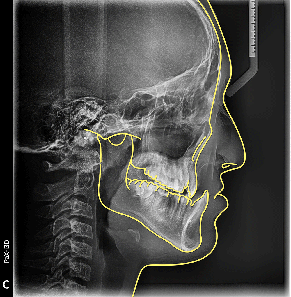 兔唇怎么治疗（兔唇怎么修复）