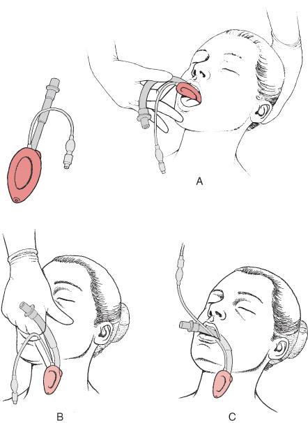 上麻醉还要在嘴里插个管子听起来真恐怖