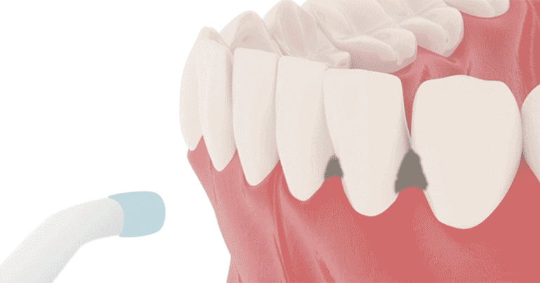 健康人每一克牙垢就有100亿个细菌你还敢不刷牙吗