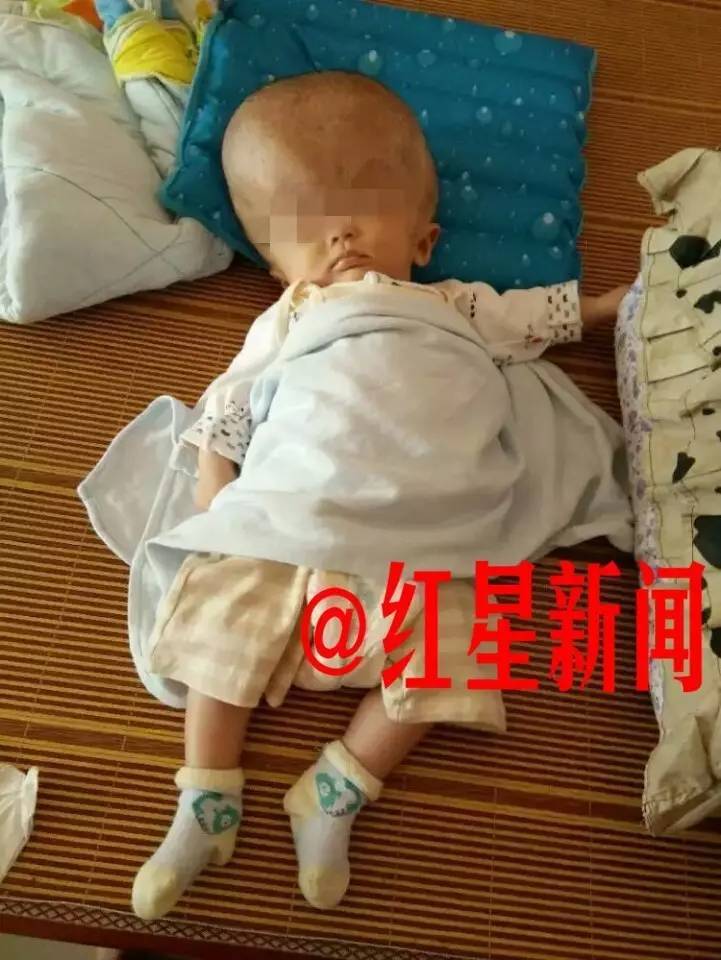 湖南病童似外星人 妈妈用针管抽脑积水_腾讯网