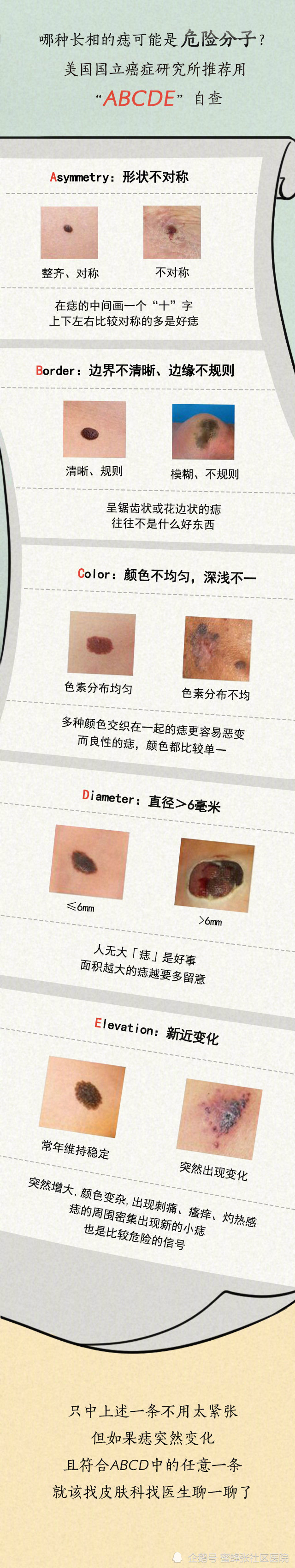 在皮肤癌中,黑色素瘤属于比较"恶"的一种,病情发展迅速,易转移,死亡