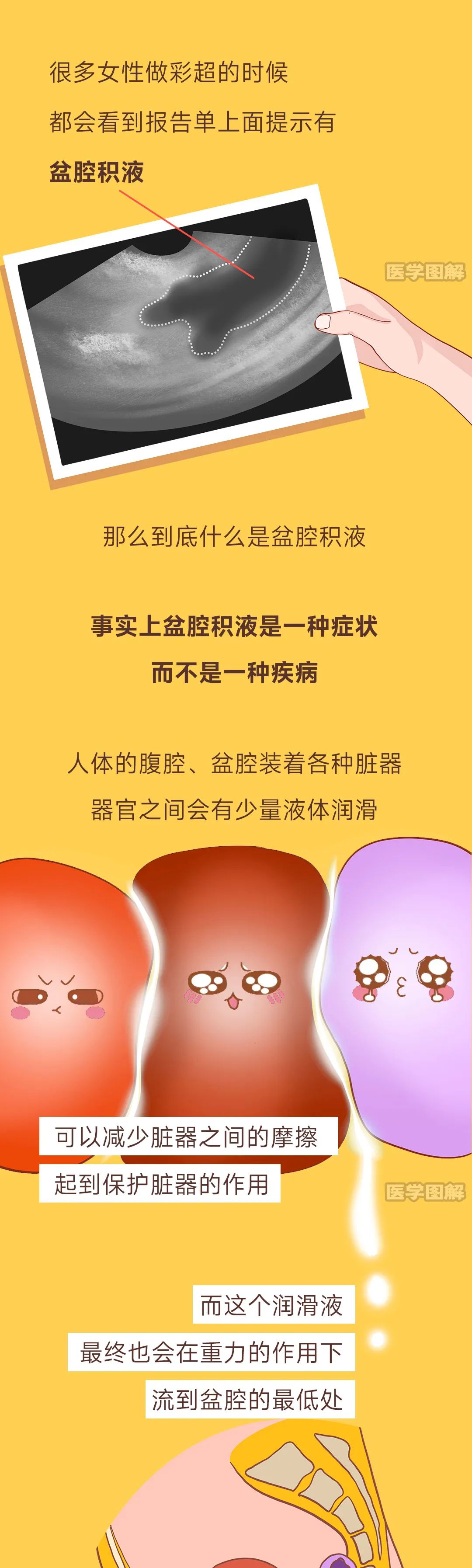 盆腔积液液体从哪来的到底用不用治丨医学图解