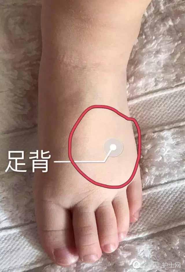 前臂水肿、全身皮疹,皮试部位该如何选择?